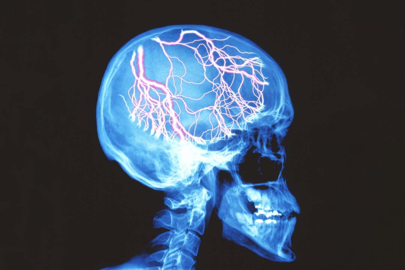 Migraine medicine that treats headaches also facilitates symptoms such as dizziness