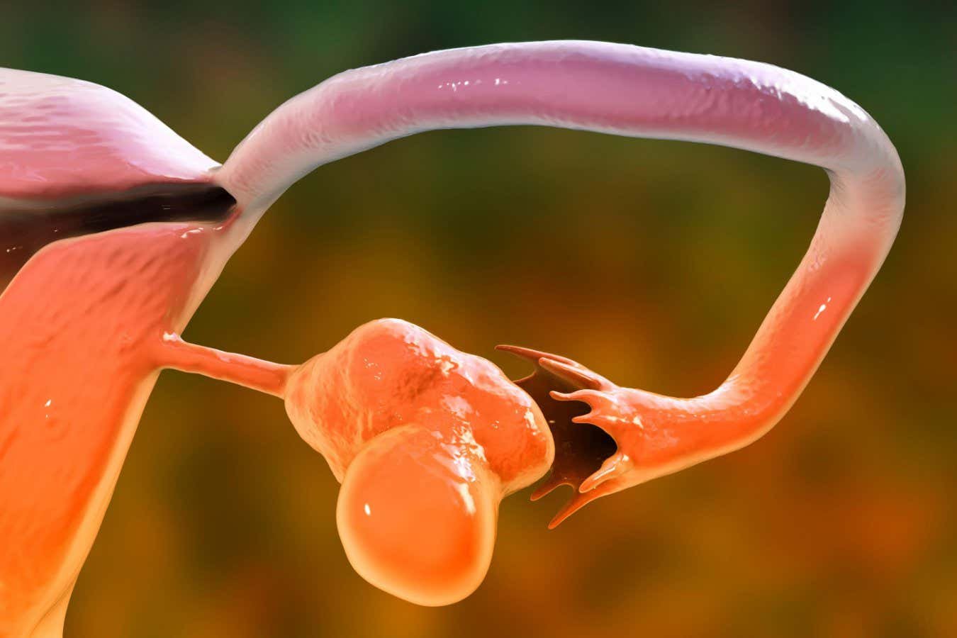 Polycystic ovarian syndrome can be passed via chemical tags on DNA