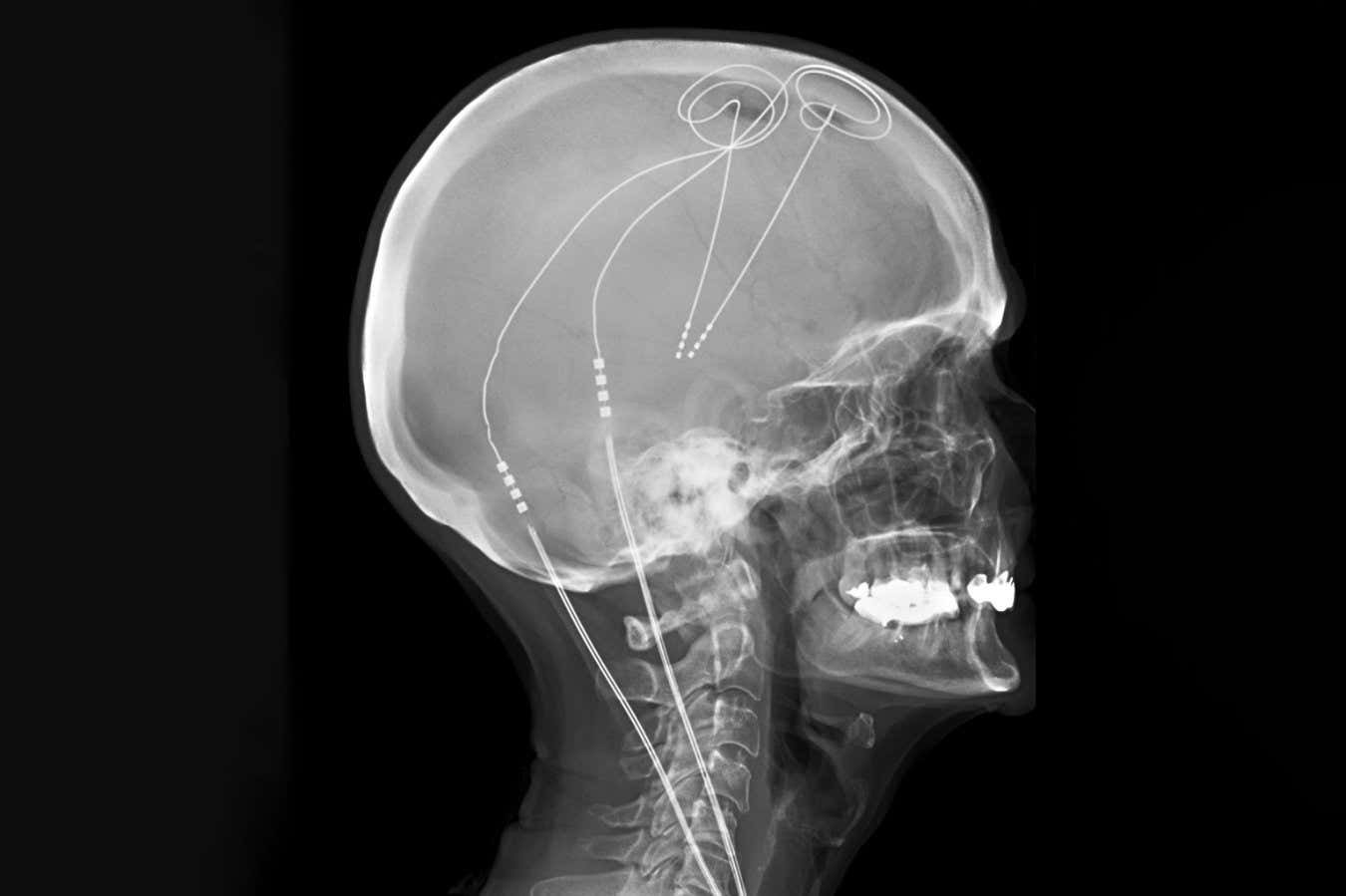 Tailor -made brain implant provides prolonged relief of chronic pain