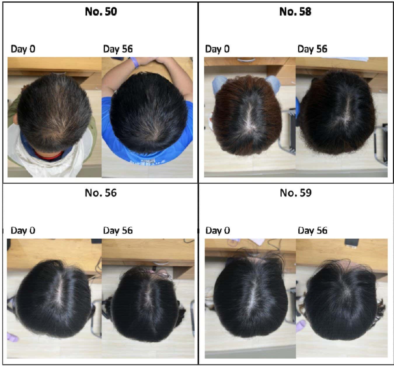 The improvement in hair growth among different participants in group five after 56 days after using the serum